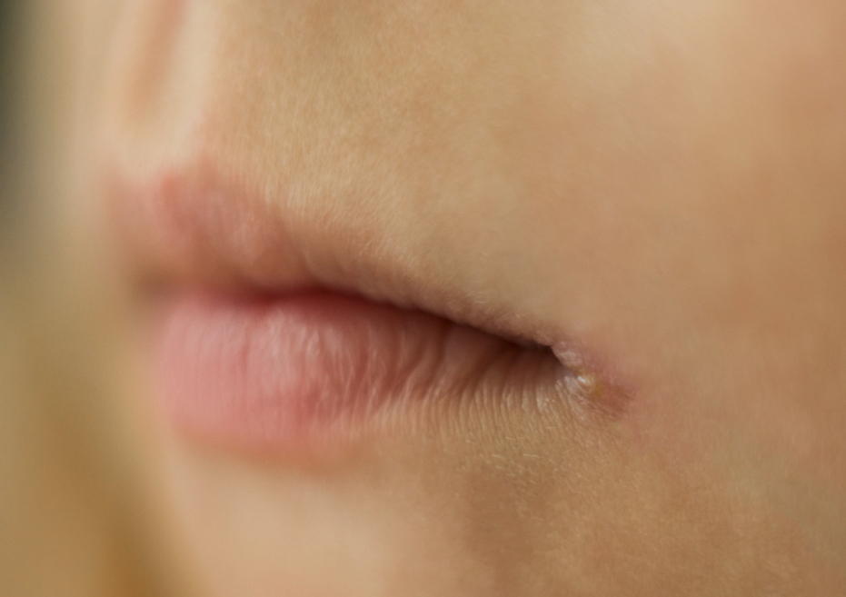 Stomatitis Angularis (Angular Cheilitis)
